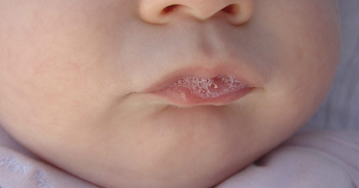 Môže dieťa dostať pľuzgiere na svoje najvyššie pery od dojčenia?