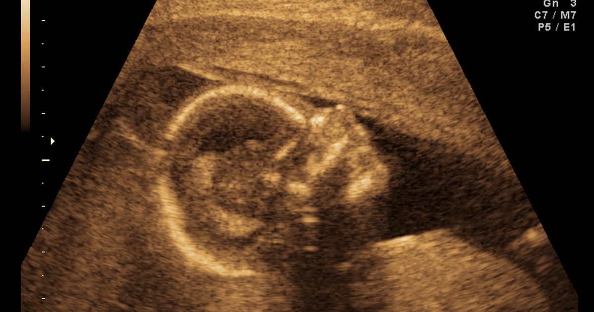 Kann die Herzfrequenz das Geschlecht eines Babys vorhersagen?