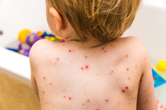 Симптомите на варицела при малки деца