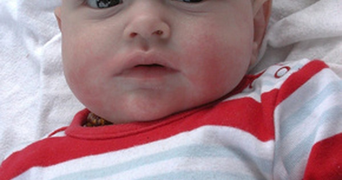 Diastasis Recti hos spädbarn