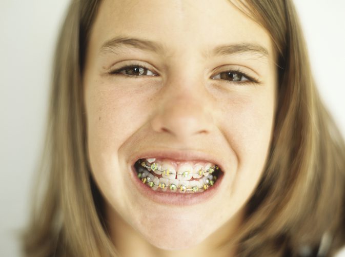 Jak jsou odstraněny šlachy zubů?