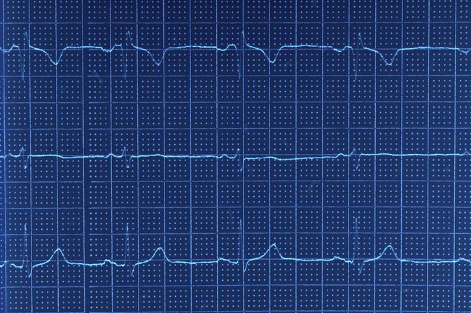 Abnormálne EKG vlny