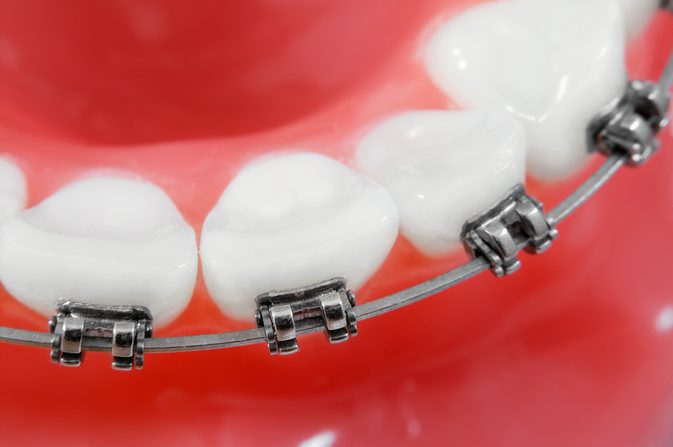 Co robić, gdy dzieci potrzebują aparatów ortodontycznych i nie możesz im na to pozwolić